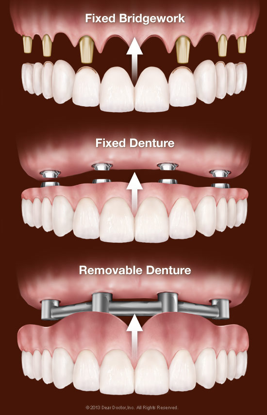 replacing-all-teeth-with-dental-implants
