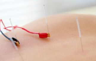 ElectroAcupuncture.jpg