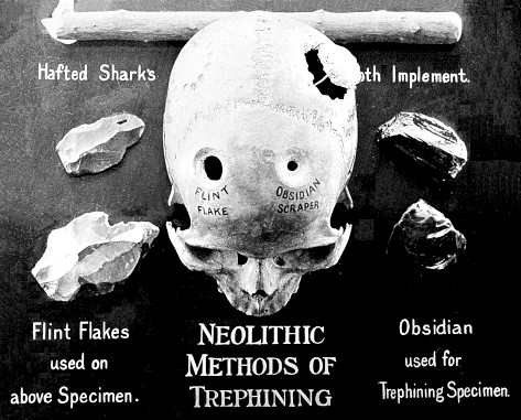 neolithic_trepanning_tools_T_Wilson_Parr