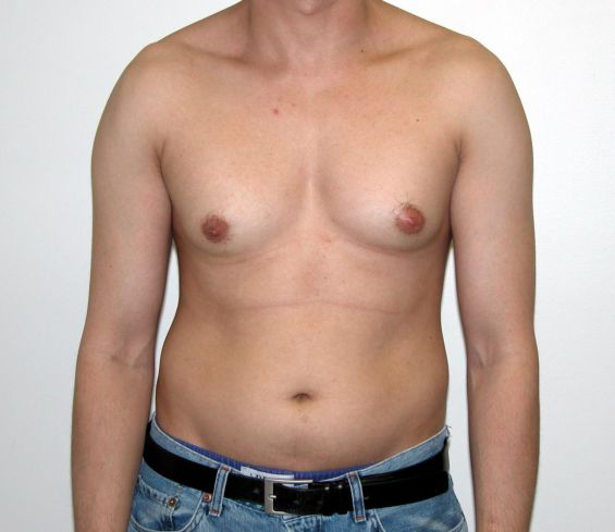 Gynecomastia-or-man-boobs-causes-and-pre