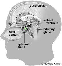 Pituitary Tumors: adenoma, craniopharyngioma, cyst basic level