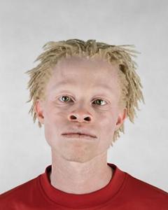 albino_african_americans.jpg?w=240&h=300